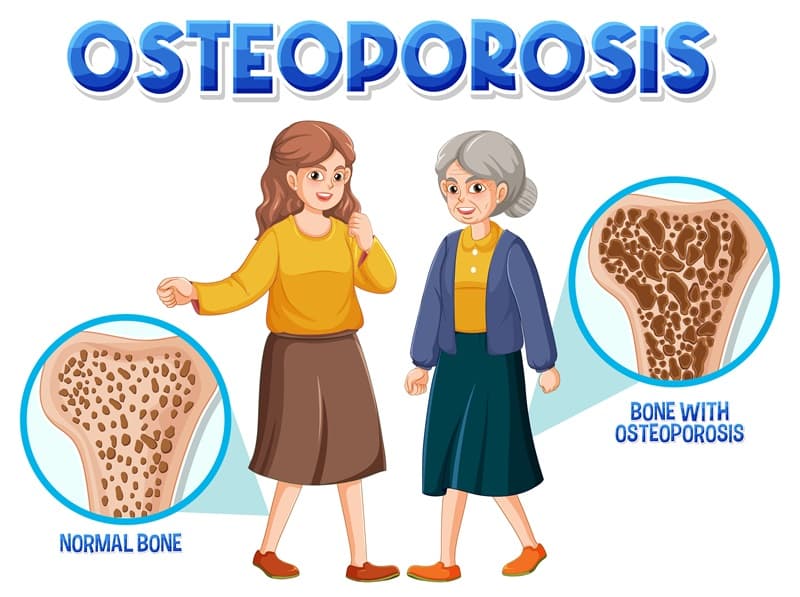 Osteoporosis
